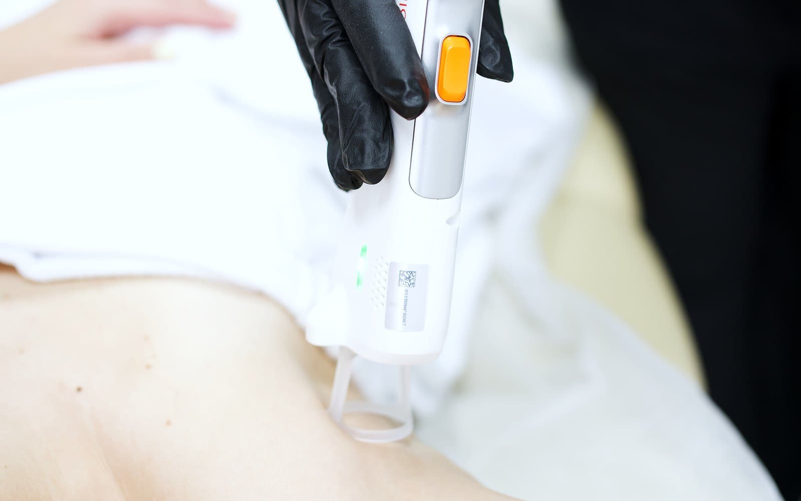 Laser hair removal treatment in progress at a Calgary clinic