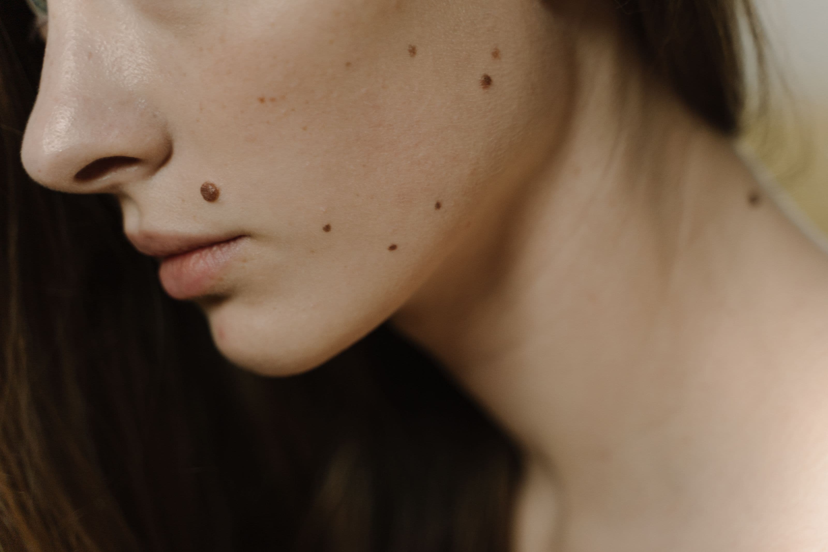 Close-up of facial moles and pigmented spots — the kind treated with Freezpen cryotherapy at LaserPeak Spa, Calgary